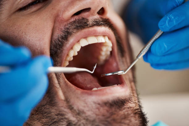 Best Emergency Tooth Extraction in Fairfax, OH