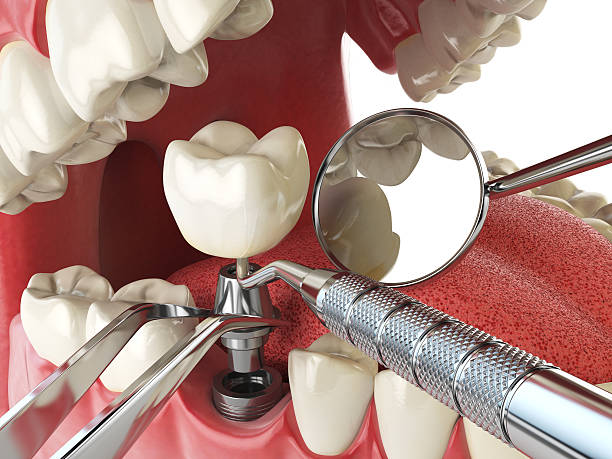Best Emergency Denture Repair in Fairfax, OH